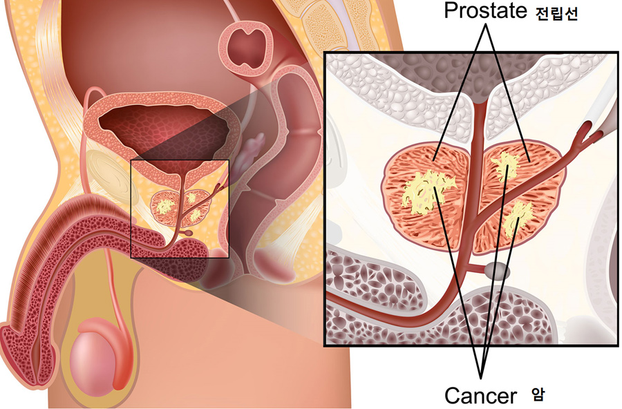 전립선암_1.jpg
