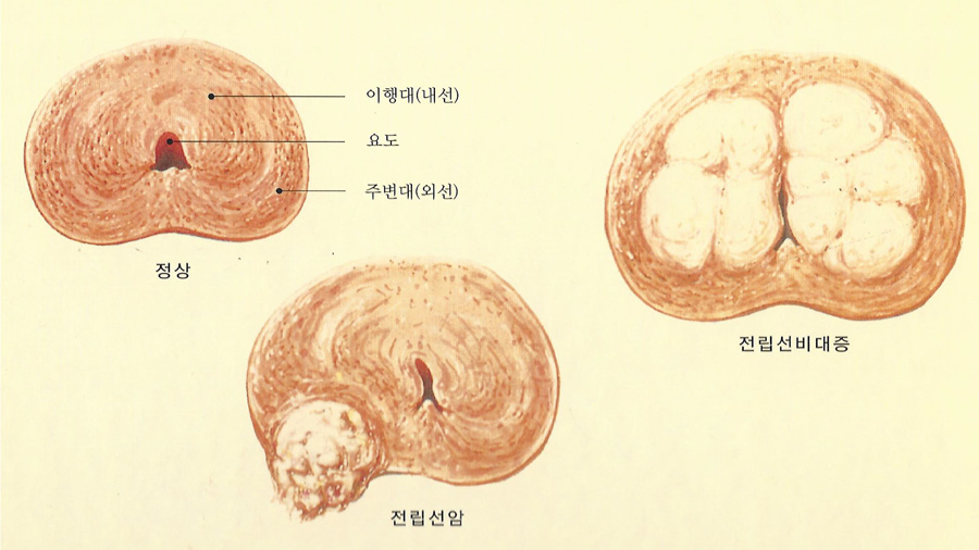 전립선단면도2_1.jpg