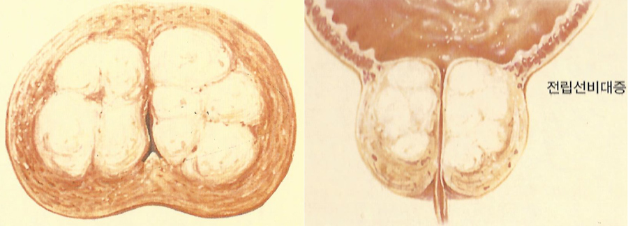 전립선비대증_1.jpg